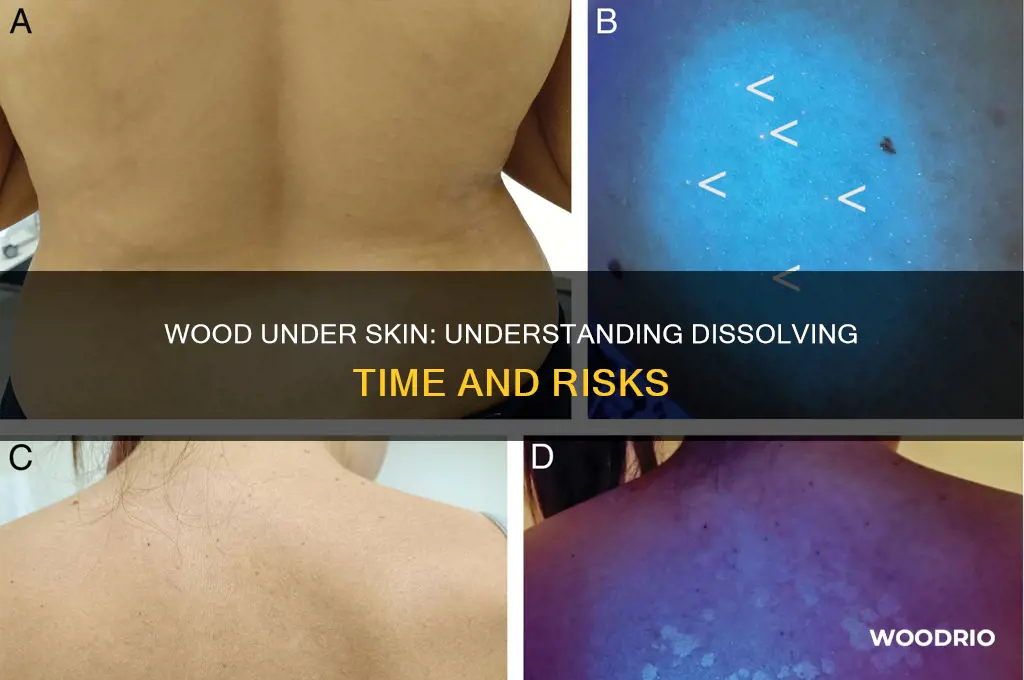how long dose it take wood 2 disolve under skin