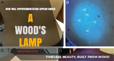 Unveiling Skin Secrets: Hypopigmentation Under Wood's Lamp