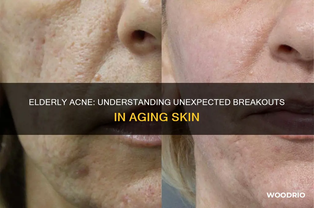 why wood a 80 year old man have acne breakout